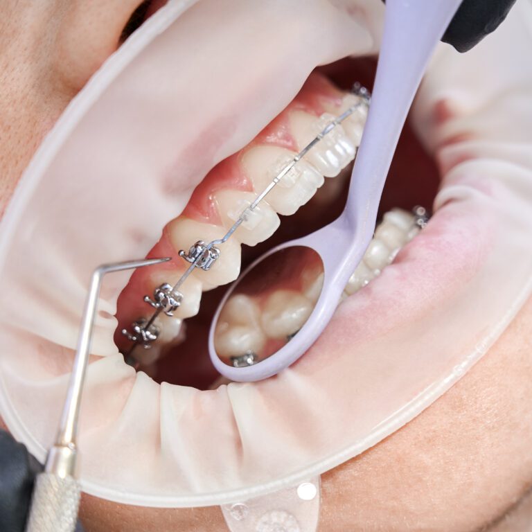 Dentist attaching metal braces to patient teeth.