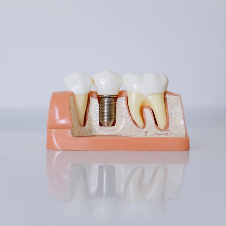 implante diente